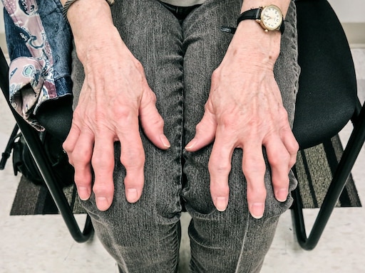 Начальная стадия подагры на руках фото Начальная стадия подагры на руках фото